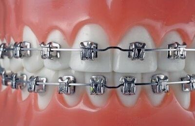 成人牙齿矫正要多久？