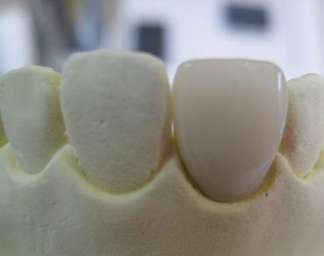 烤瓷牙修复的优势在哪？