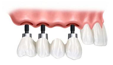 多颗种植牙术前应做哪些检查？