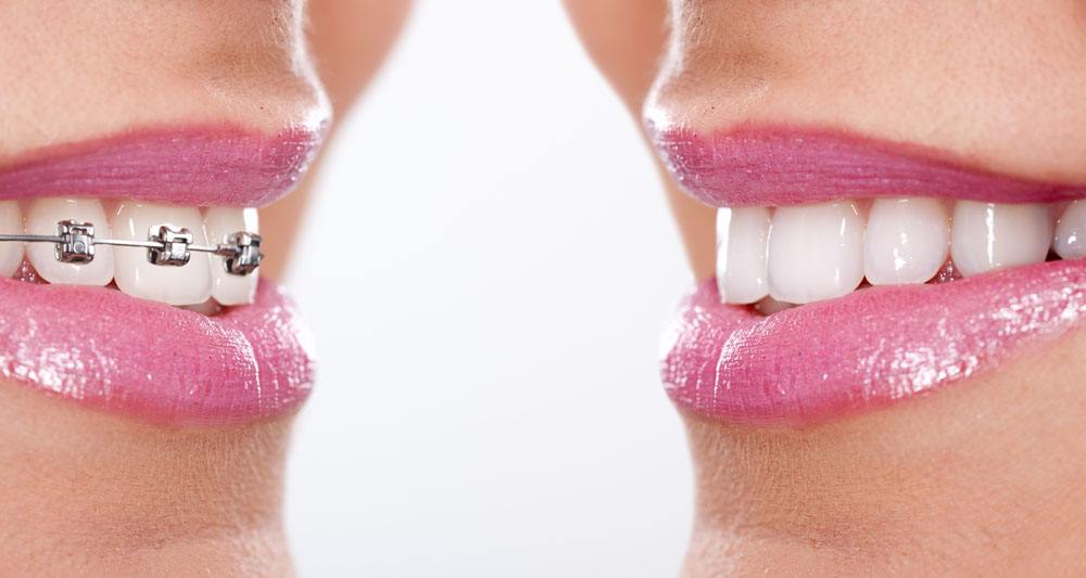 牙齿矫正期间人会瘦吗？
