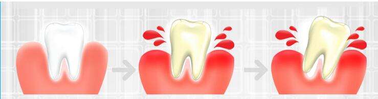 牙龈出血该怎么缓解呢？