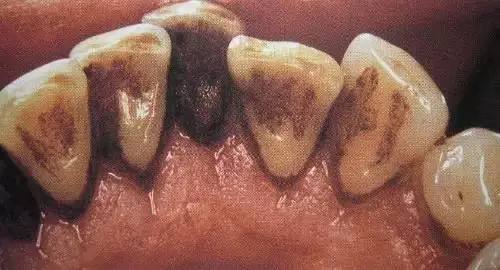 牙周炎首要治疗方法？