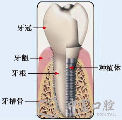 种植牙要怎么选？