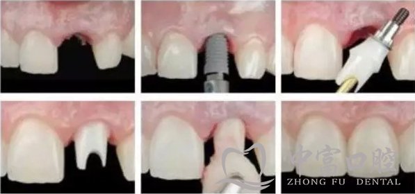 牙齿缺损修复要趁早